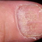 Лечение дистрофия ногтя: фото и причины истончения