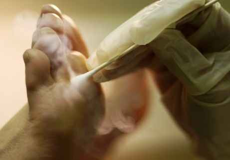 Бородавки между пальцами ног причины и методы избавления