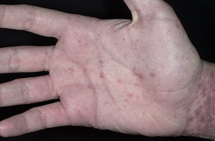 Тяжёлая форма хронического заболевания кожи