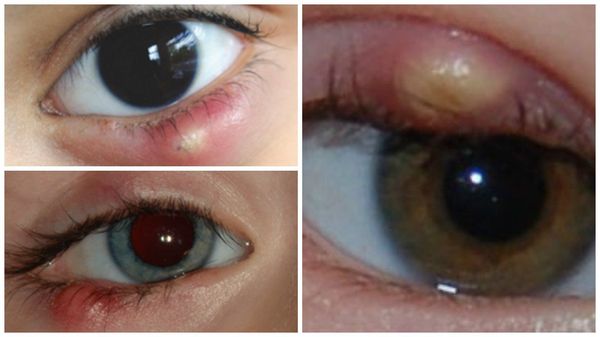 Халязионы на глазах