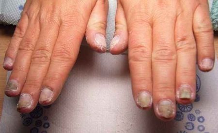 Дрожжевой грибок на ногтях рук лечение