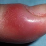 Воспаление околоногтевого валика на руке: как лечить паронихии