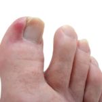 Как лечить дикое мясо на пальце ноги?
