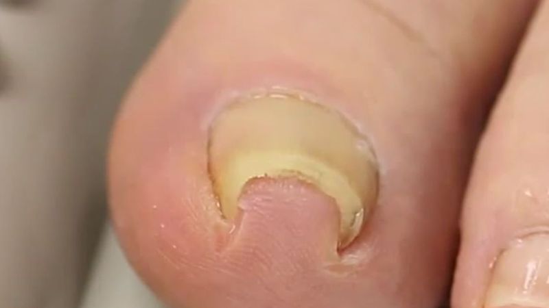 Эффективность аппаратной чистки ногтей от грибка