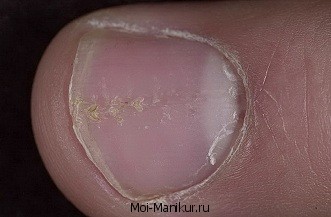Чем лечить псориаз ногтей на ногах, фото пораженных пластин