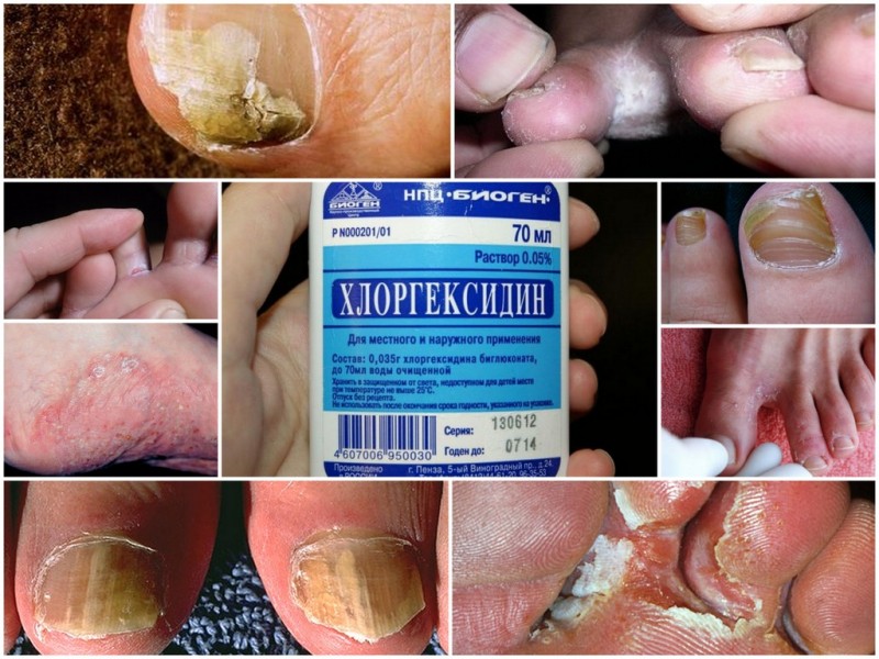 Поможет от грибковой инфекции кожи и ногтей