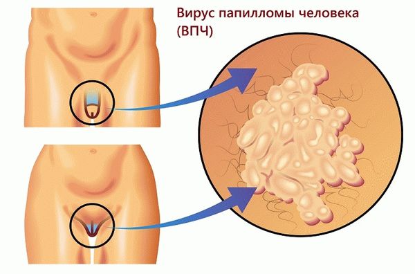 Все о папилломах на половых органах гениталиях