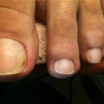 Трескается кожа на пальцах ног: причины и лечение