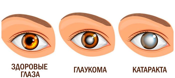 Заболевание глаз - катаракта и глаукома