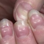 Почему ломаются ногти на руках у женщин и мужчин?