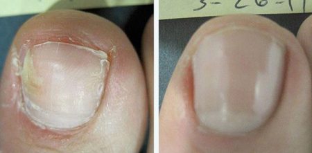 Противогрибковое средство Serrix B.V. Набор Микозан для удаления грибкового поражения с ногтевой пластины - отзыв