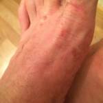 Покраснение на большом пальце ноги около ногтя: что это и почему чешется ступня?