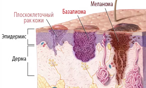 Гистология базальноклеточной папилломы