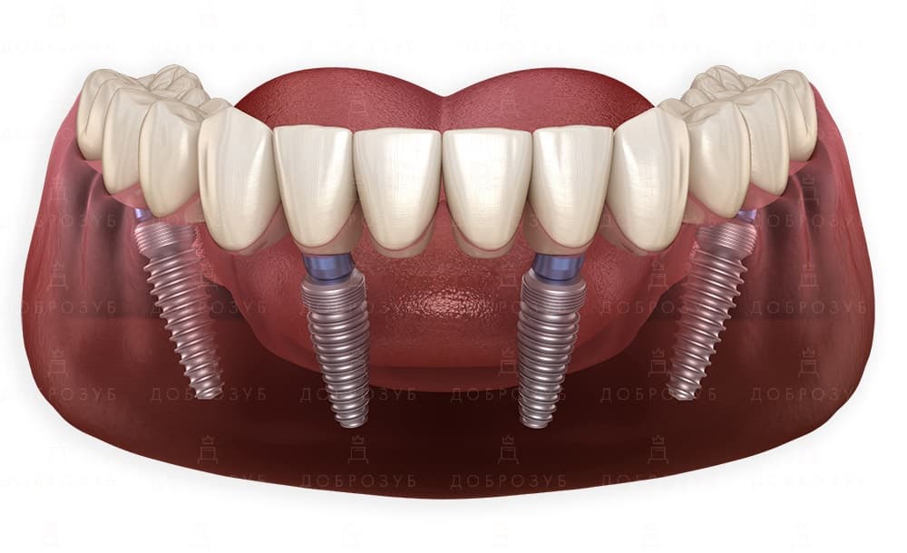 Инновационные технологии в стоматологии: Разбираемся в All-on-4